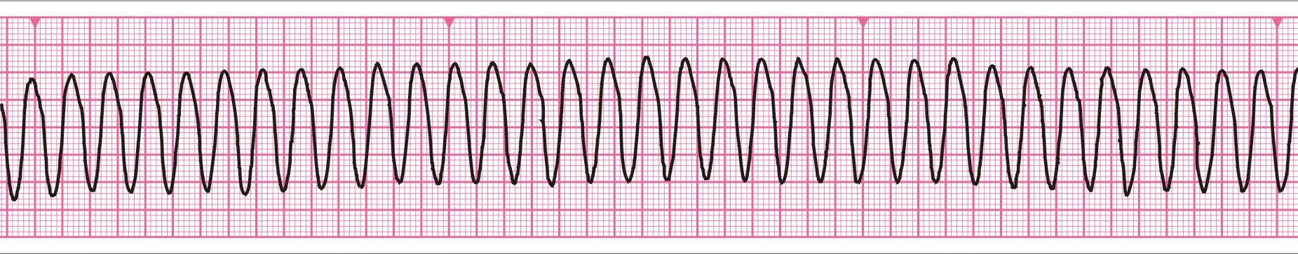 Zapis EKG